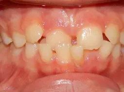 Example of crossbite in a child