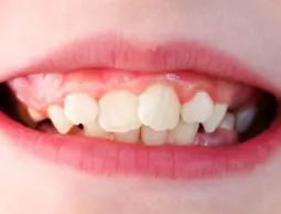 Example of crowded or crooked teeth in a child