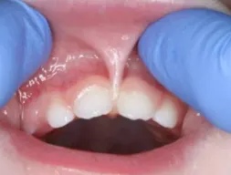 Example of lip tie in a child