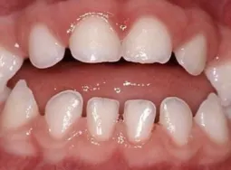 Example of open bite in a child