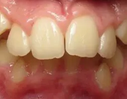 Example of overbite or deep bite in a child