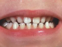 Example of teeth tipped in in a child