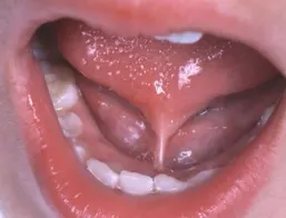 Example of tongue tie in a child