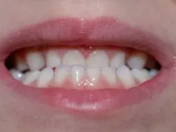 Example of underbite in a child